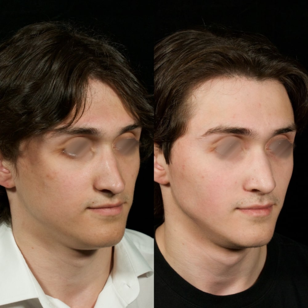 Septorhinoplasty Before & After Image