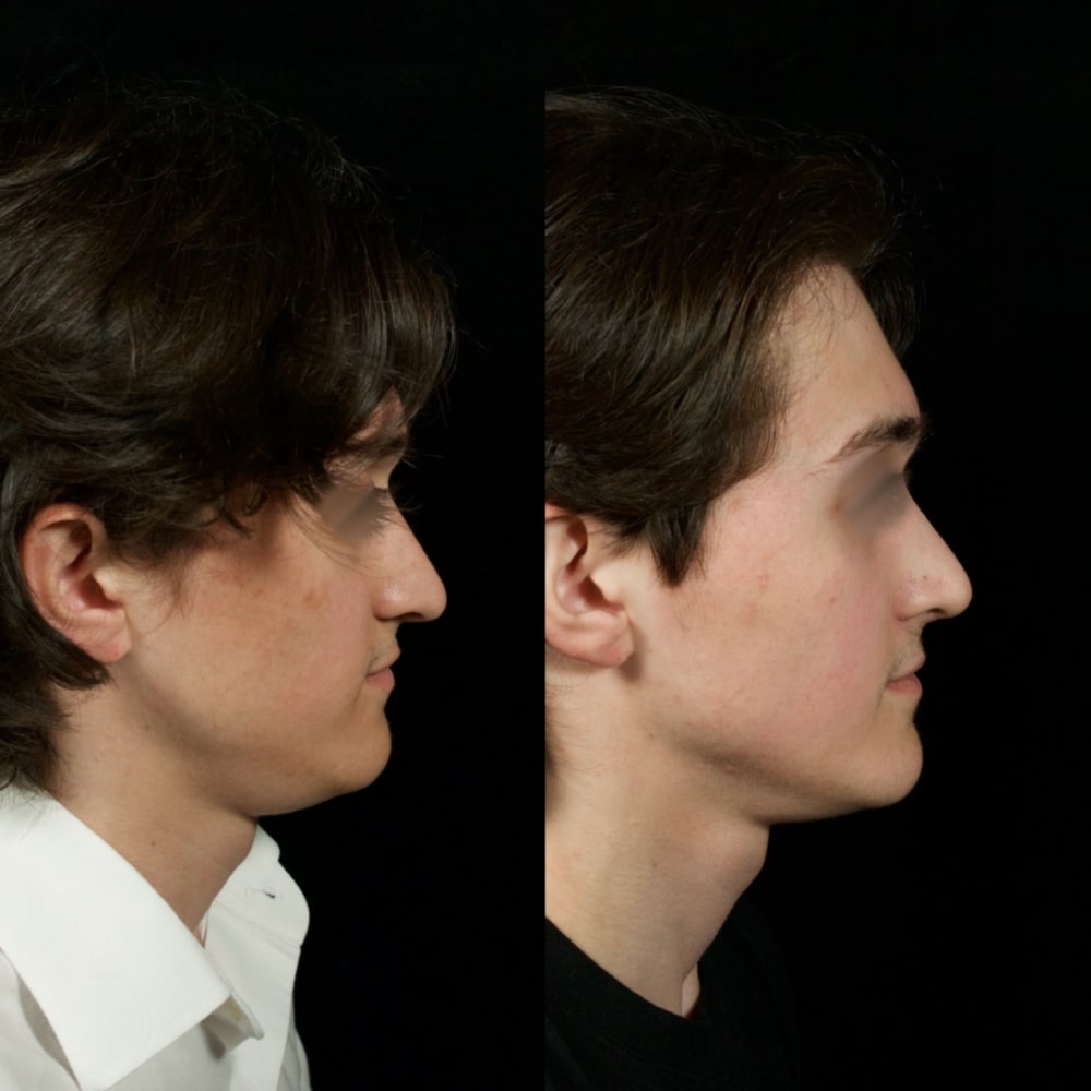 Septorhinoplasty Before & After Image