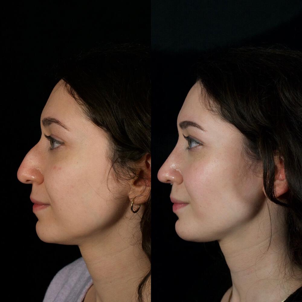 Septorhinoplasty Before & After Image