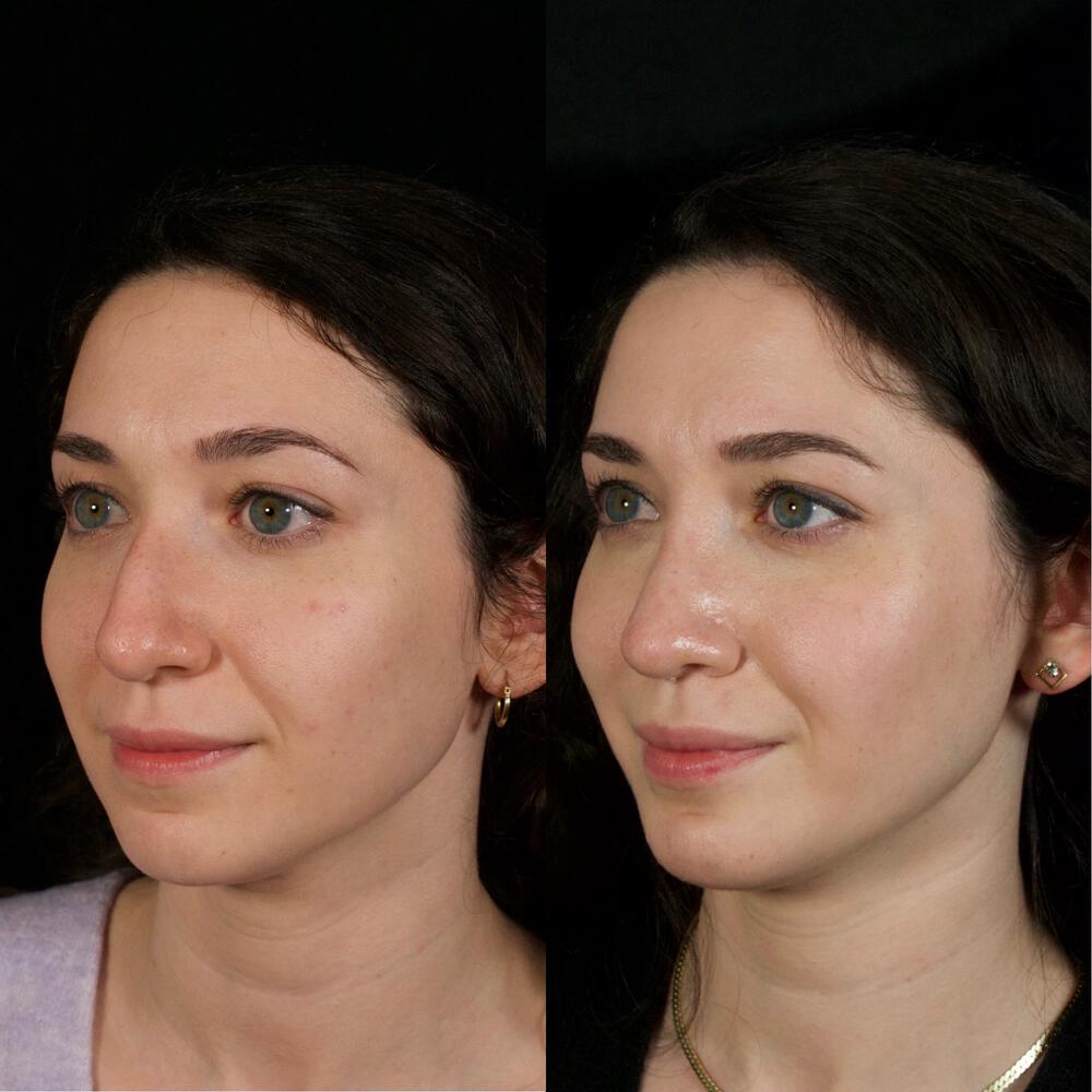 Septorhinoplasty Before & After Image