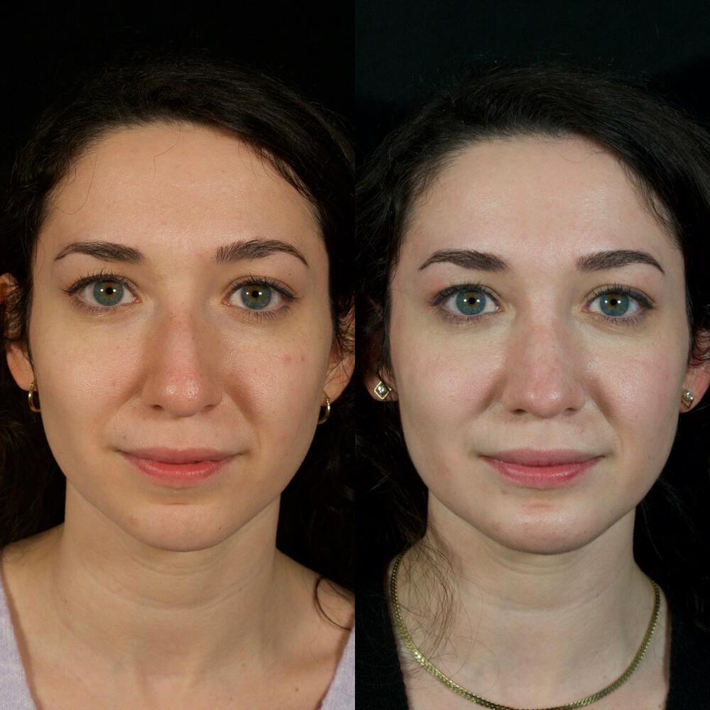 Septorhinoplasty Before & After Image