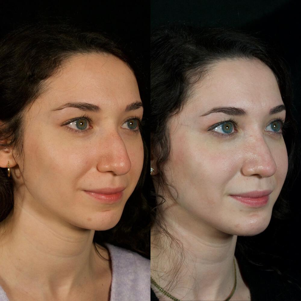 Septorhinoplasty Before & After Image