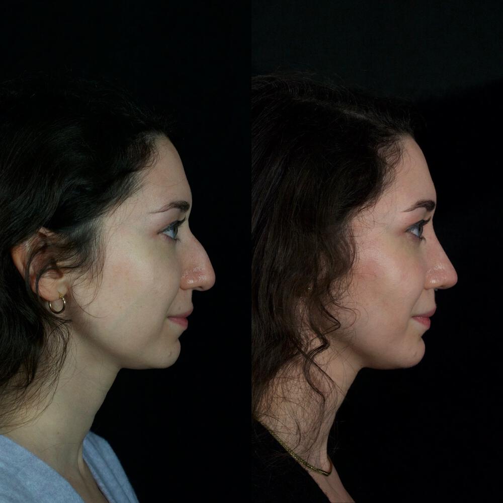 Septorhinoplasty Before & After Image