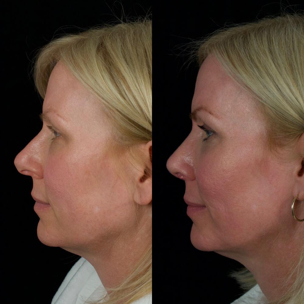 Septorhinoplasty Before & After Image