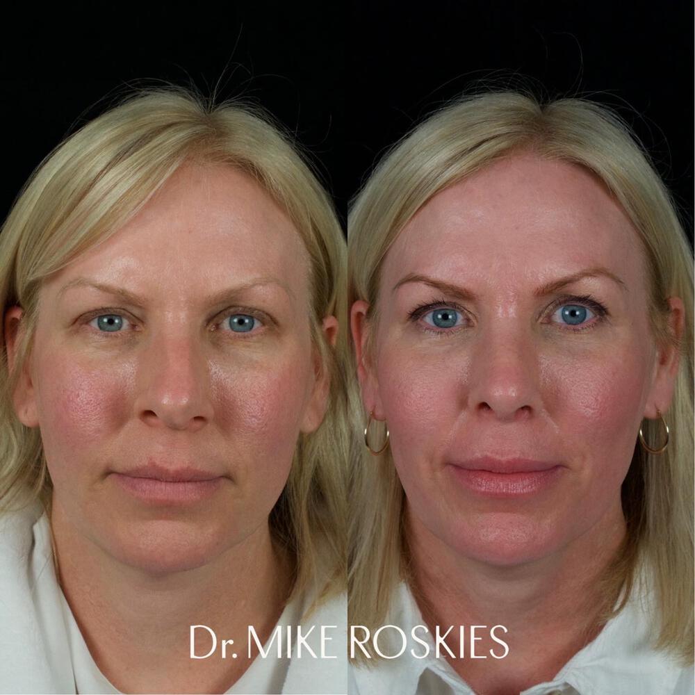 Septorhinoplasty Before & After Image