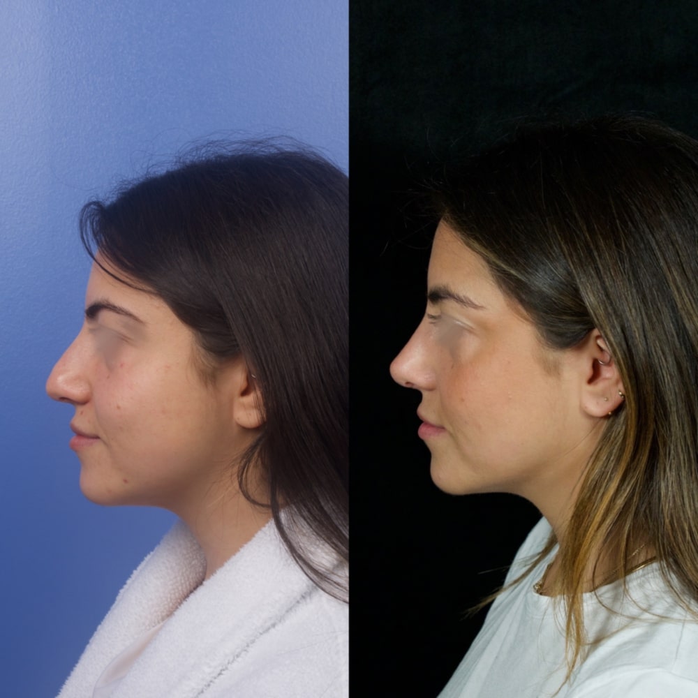 Septorhinoplasty Before & After Image