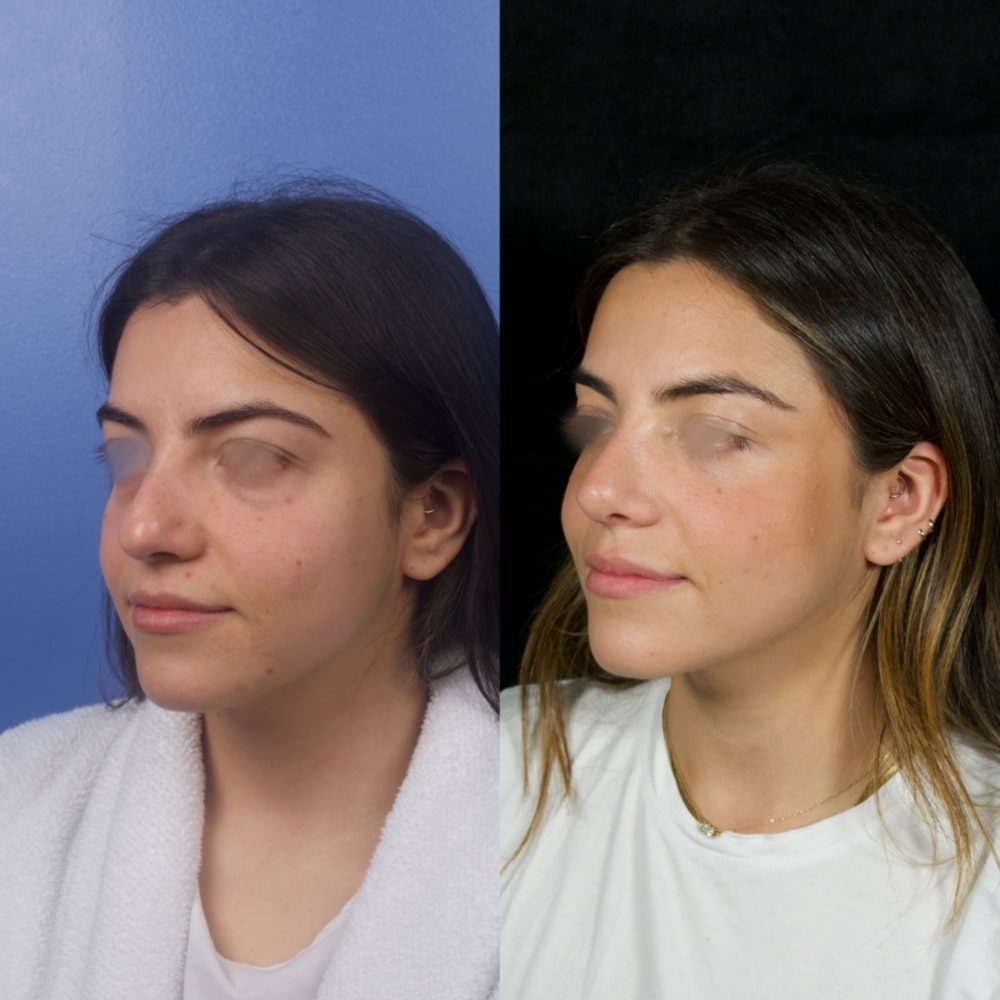 Septorhinoplasty Before & After Image