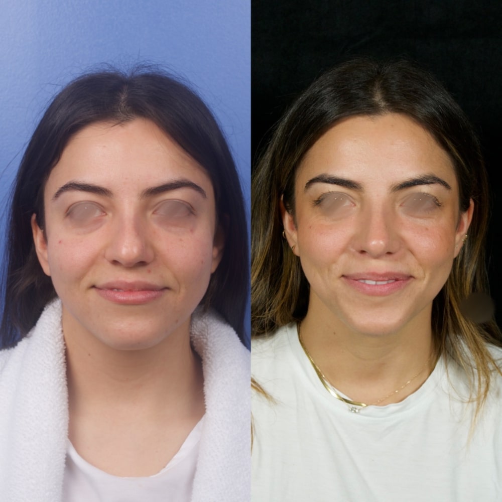 Septorhinoplasty Before & After Image