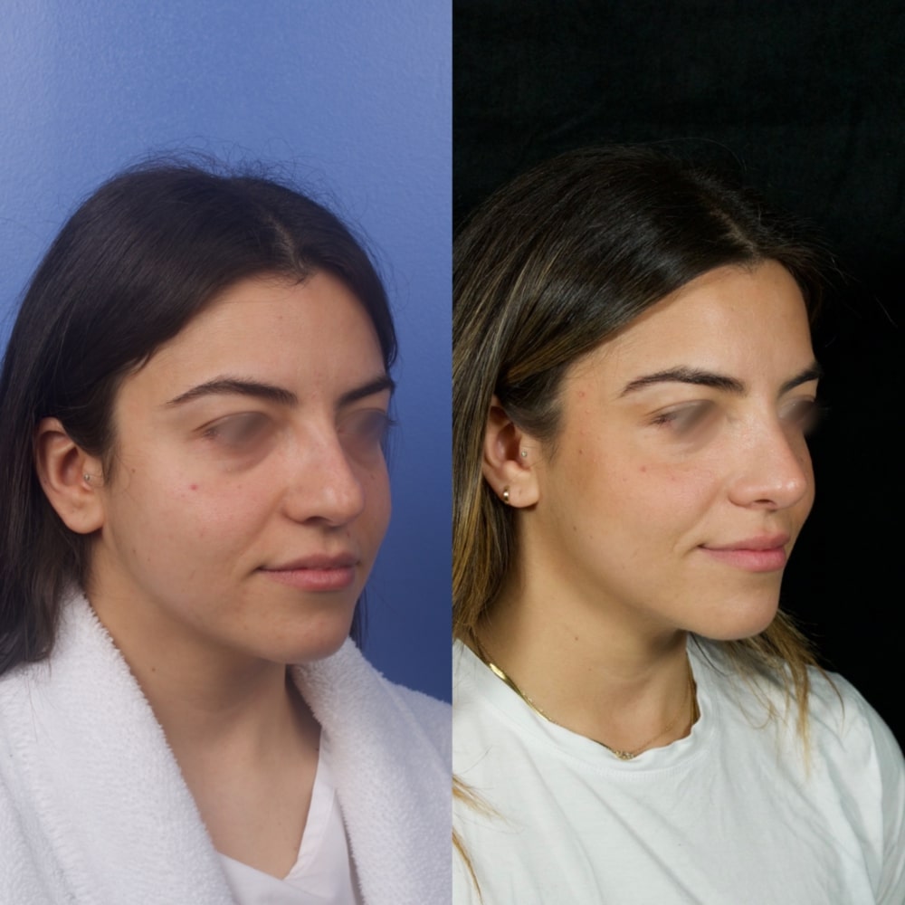 Septorhinoplasty Before & After Image