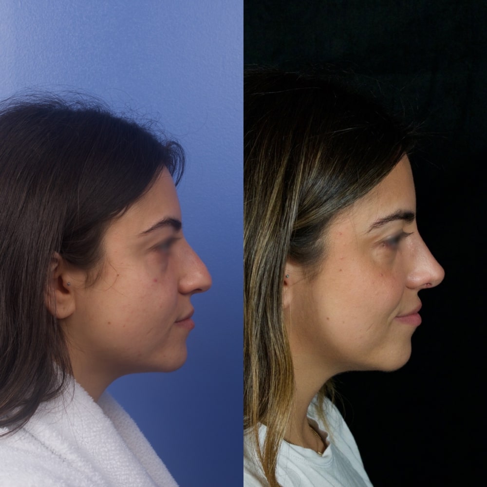 Septorhinoplasty Before & After Image