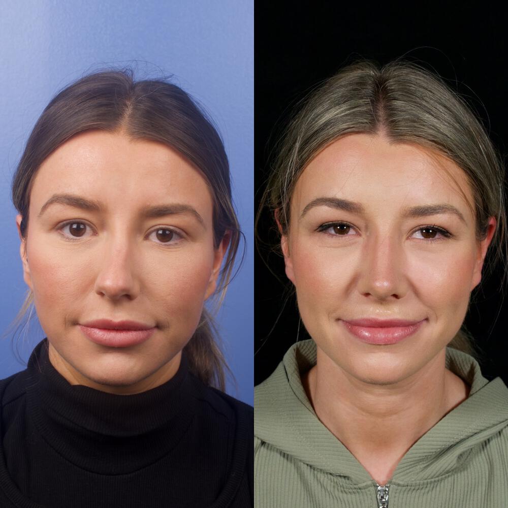 Septorhinoplasty Before & After Image