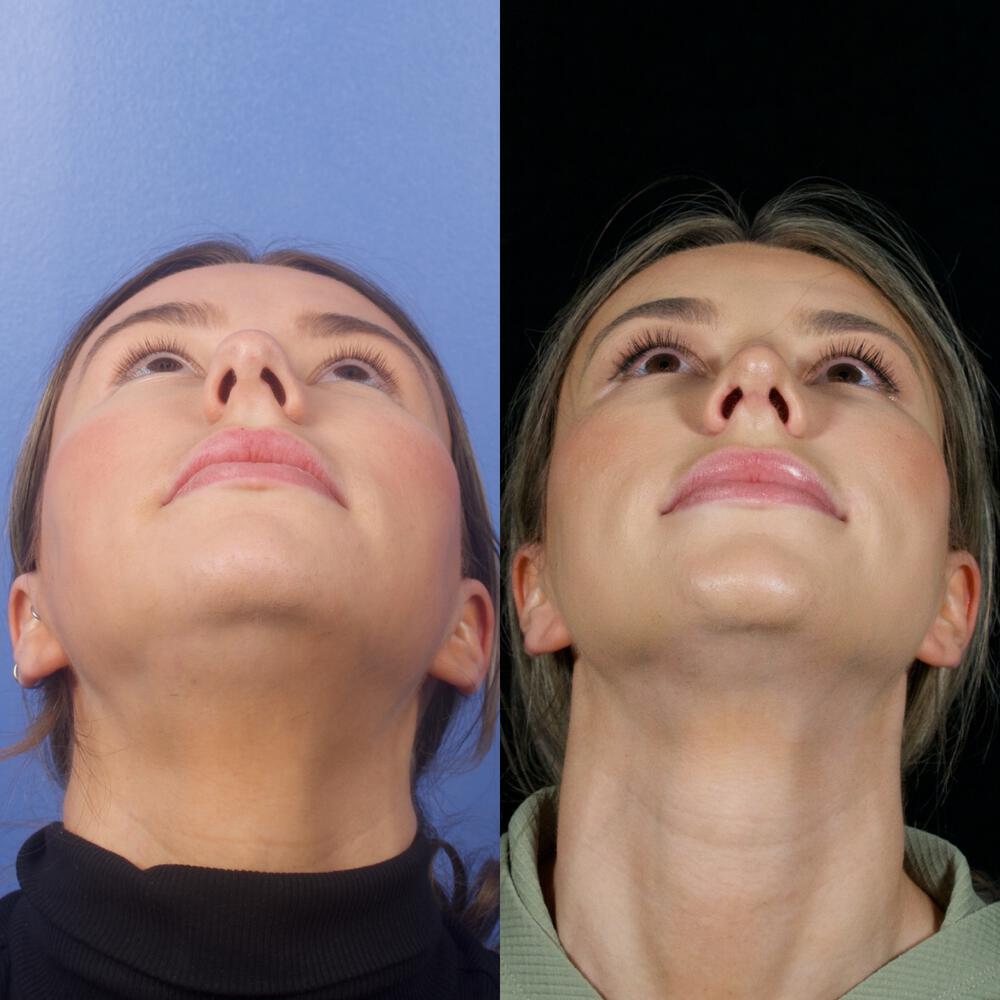 Septorhinoplasty Before & After Image