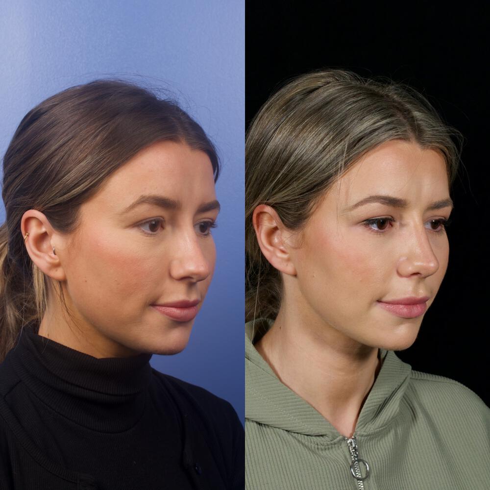 Septorhinoplasty Before & After Image