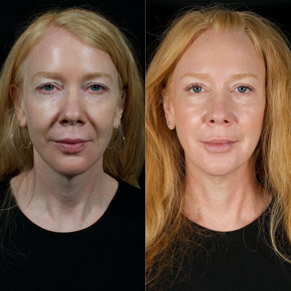 Upper-Eyelid Surgery Before & After Image
