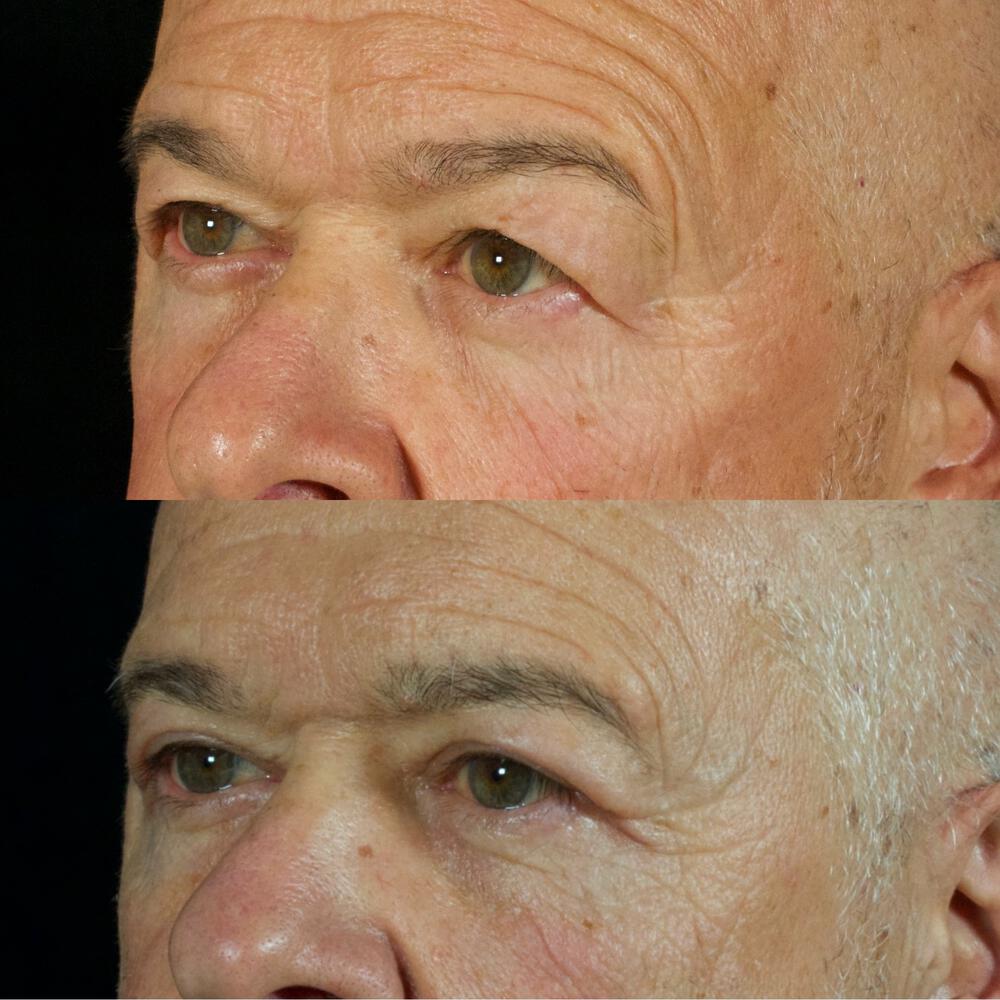 Upper-Eyelid Surgery Before & After Image